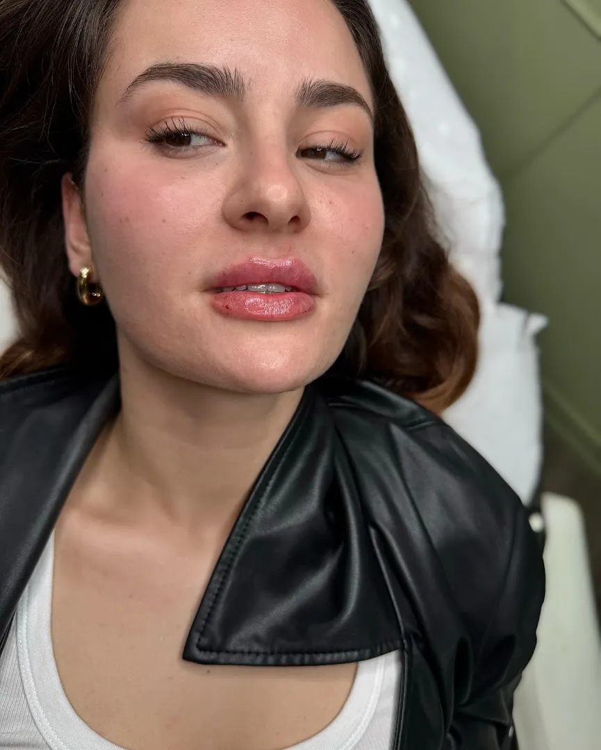 Needle facial — Miss HG — Beauty salon in Romford